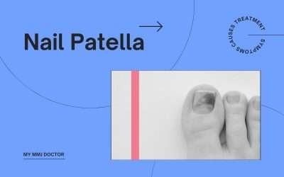 Nail Patella Syndrome: Causes, Symptoms, and Treatment