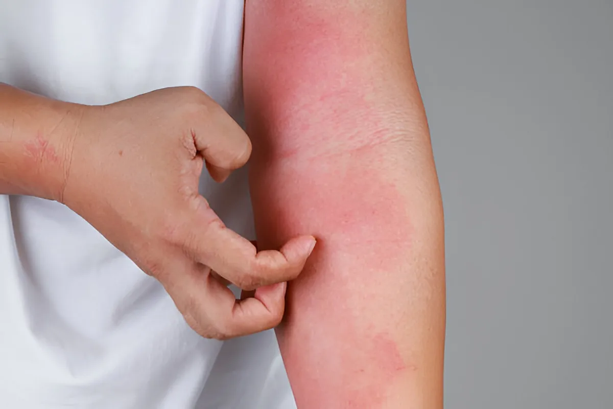 red inflamed arm illustrating inflammation symptom red inflamed arm illustrating inflammation symptom